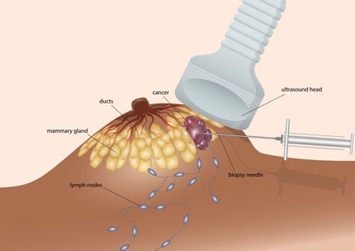 Core Biopsy