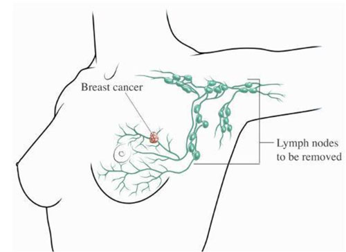 The Role of Lymph Node Surgery in Breast Cancer