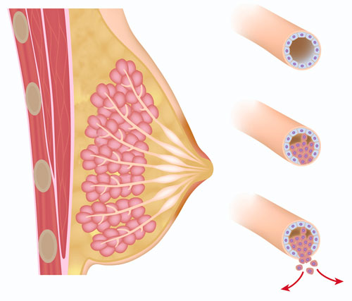 How does Breast Cancer Develop?