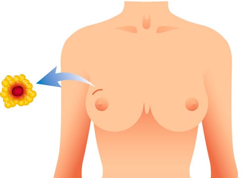 Surgical Biopsy